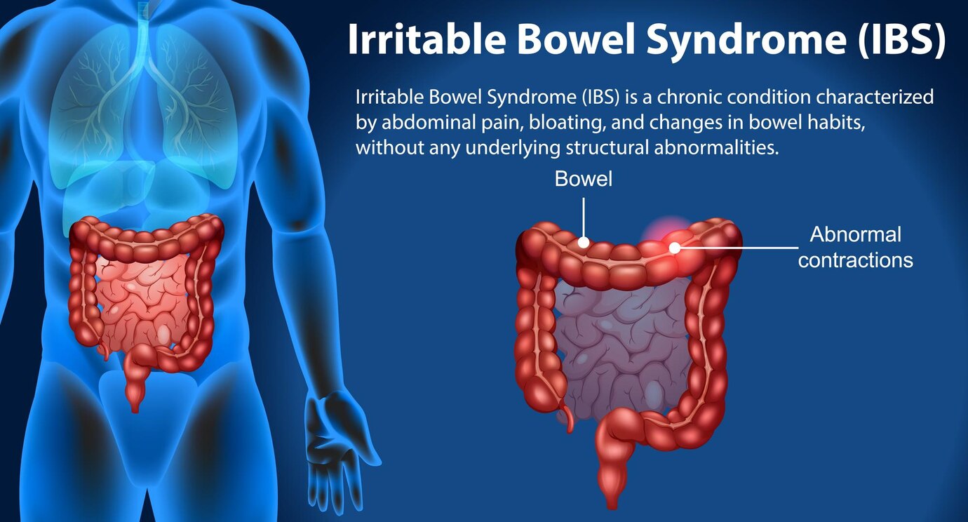 Understanding Irritable Bowel Syndrome (IBS): Symptoms, Triggers, and Management