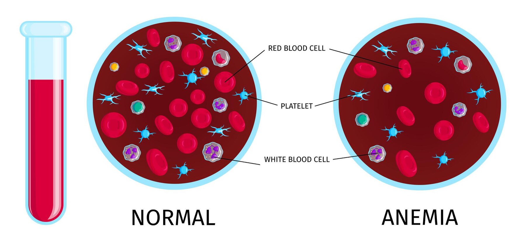 Understanding Anemia: Causes, Symptoms, and Treatment Options
